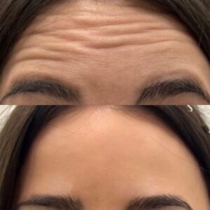 Frontal 3